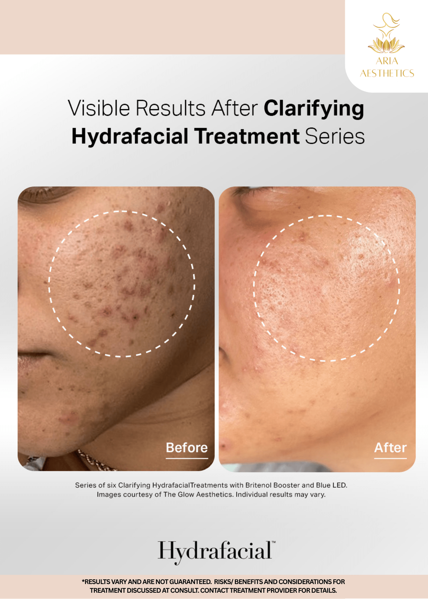 Hydrafacial Treatment before and after results Hydrafacial Treatment before and after results