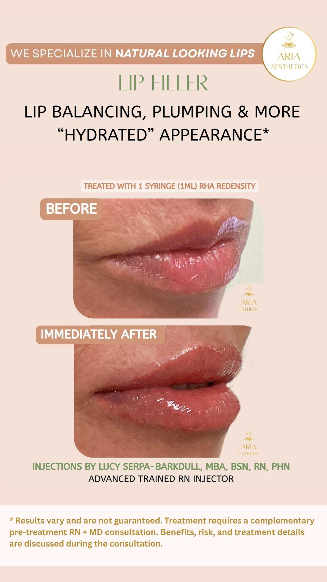 Botox lip flip treatment before and after results