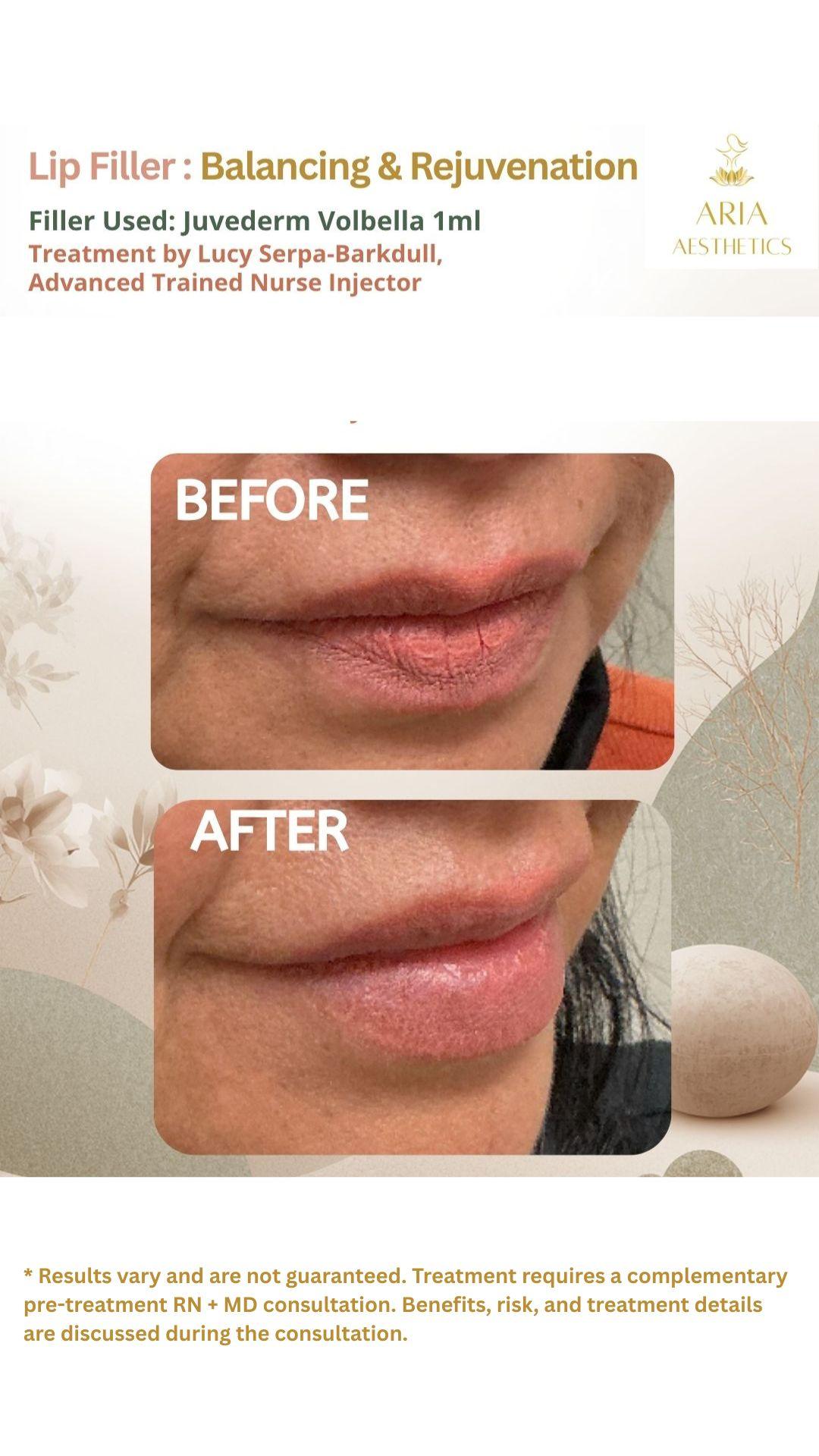 Mini Lip Filler treatment- Before & After - Beautiful Results